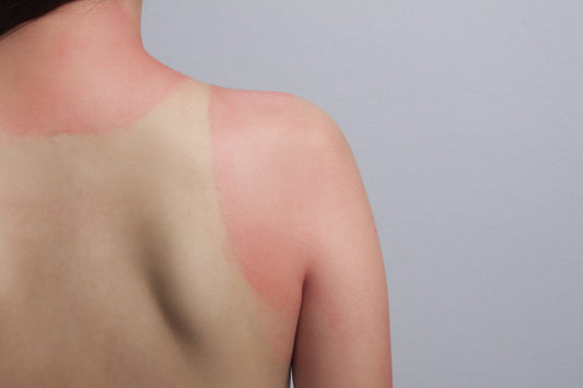 Prevent Sun Damaged Skin with Everyday Sunscreen