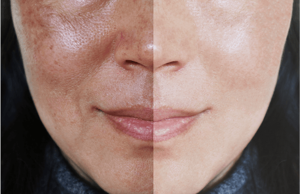 The Truth About Melasma Every Woman Needs To Know