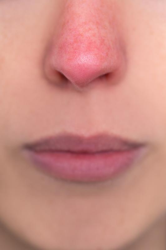 Soothe Your Skin: 5 Natural Remedies for Rosacea