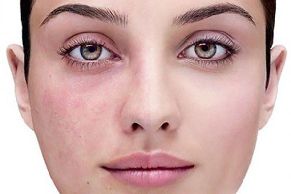 Soothe Your Skin: 5 Natural Remedies for Rosacea